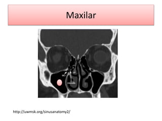 Maxilar
http://uwmsk.org/sinusanatomy2/
 