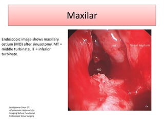 Maxilar
Endoscopic image shows maxillary
ostium (MO) after sinusotomy. MT =
middle turbinate, IT = inferior
turbinate.
Multiplanar Sinus CT:
A Systematic Approach to
Imaging Before Functional
Endoscopic Sinus Surgery
 