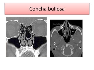 Concha bullosa
 