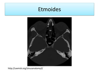 Etmoides
http://uwmsk.org/sinusanatomy2/
 