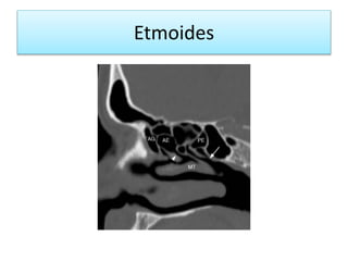 Etmoides
 