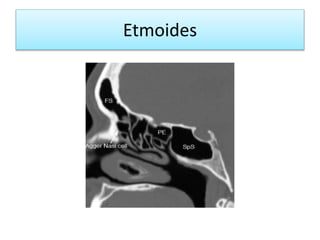 Etmoides
 