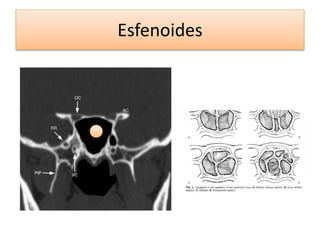 Esfenoides
 
