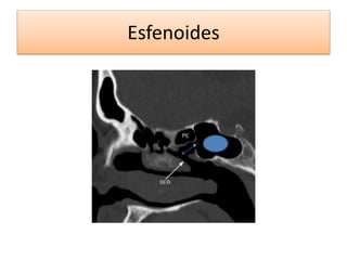 Esfenoides
 