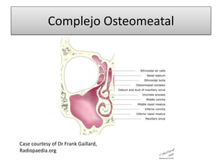 Complejo Osteomeatal
Case courtesy of Dr Frank Gaillard,
Radiopaedia.org
 