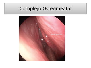 Complejo Osteomeatal
 