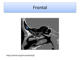 Frontal
http://uwmsk.org/sinusanatomy2/
 