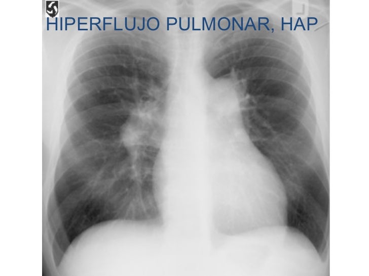 hipertensión arterial complicaciones opciones