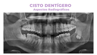 CISTO DENTÍGERO
Aspectos Radiográficos
 