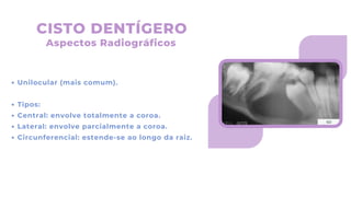 Unilocular (mais comum).
Tipos:
Central: envolve totalmente a coroa.
Lateral: envolve parcialmente a coroa.
Circunferencial: estende-se ao longo da raiz.
CISTO DENTÍGERO
Aspectos Radiográficos
 