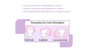 Central: envolve totalmente a coroa.
Lateral: envolve parcialmente a coroa.
Circunferencial: estende-se ao longo da raiz.
 