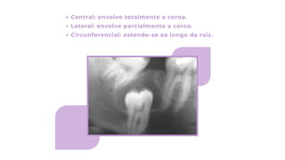 Central: envolve totalmente a coroa.
Lateral: envolve parcialmente a coroa.
Circunferencial: estende-se ao longo da raiz.
 
