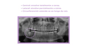 Central: envolve totalmente a coroa.
Lateral: envolve parcialmente a coroa.
Circunferencial: estende-se ao longo da raiz.
 