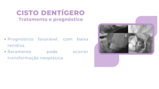 .
Prognóstico favorável, com baixa
recidiva.
Raramente pode ocorrer
transformação neoplásica.
CISTO DENTÍGERO
Tratamento e prognóstico
 