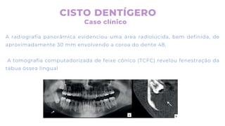 A radiografia panorâmica evidenciou uma área radiolúcida, bem definida, de
aproximadamente 30 mm envolvendo a coroa do dente 48.
A tomografia computadorizada de feixe cônico (TCFC) revelou fenestração da
tábua óssea lingual
CISTO DENTÍGERO
Caso clínico
 