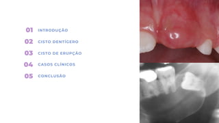 01
02
03
04
05
INTRODUÇÃO
CISTO DENTÍGERO
CISTO DE ERUPÇÃO
CASOS CLÍNICOS
CONCLUSÃO
 