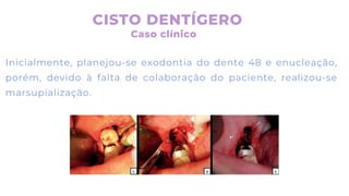 Inicialmente, planejou-se exodontia do dente 48 e enucleação,
porém, devido à falta de colaboração do paciente, realizou-se
marsupialização.
CISTO DENTÍGERO
Caso clínico
 