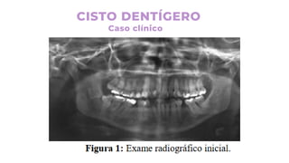 CISTO DENTÍGERO
Caso clínico
 