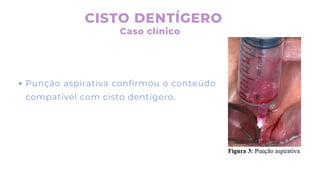 Punção aspirativa confirmou o conteúdo
compatível com cisto dentígero.
CISTO DENTÍGERO
Caso clínico
 