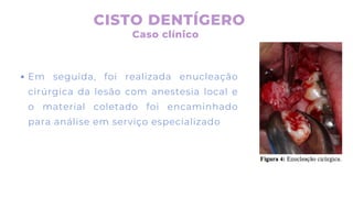 Em seguida, foi realizada enucleação
cirúrgica da lesão com anestesia local e
o material coletado foi encaminhado
para análise em serviço especializado
CISTO DENTÍGERO
Caso clínico
 