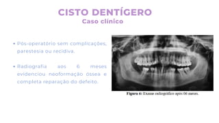 Pós-operatório sem complicações,
parestesia ou recidiva.
Radiografia aos 6 meses
evidenciou neoformação óssea e
completa reparação do defeito.
CISTO DENTÍGERO
Caso clínico
 