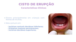 CISTO DE ERUPÇÃO
Características Clínicas
Ocorre principalmente em crianças com
menos de 10 anos;
Mais comum em:
Incisivos centrais decíduos inferiores;
Primeiros molares permanentes;
Incisivos decíduos superiores;
 