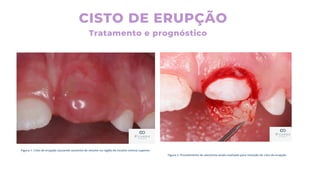 CISTO DE ERUPÇÃO
Tratamento e prognóstico
 