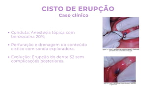 CISTO DE ERUPÇÃO
Caso clínico
Conduta: Anestesia tópica com
benzocaína 20%;
Perfuração e drenagem do conteúdo
cístico com sonda exploradora.
Evolução: Erupção do dente 52 sem
complicações posteriores.
 