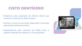 CISTO DENTÍGERO
Origina-se pela separação do folículo dental que
envolve a coroa de um dente incluso.
Envolve a coroa de um dente impactado, conectado
pela junção amelocementária.
Desenvolve-se pelo acúmulo de fluido entre o
epitélio reduzido do esmalte e a coroa dentária.
 