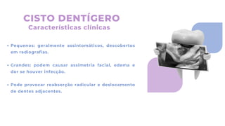 CISTO DENTÍGERO
Pequenos: geralmente assintomáticos, descobertos
em radiografias.
Grandes: podem causar assimetria facial, edema e
dor se houver infecção.
Pode provocar reabsorção radicular e deslocamento
de dentes adjacentes.
Características clínicas
 