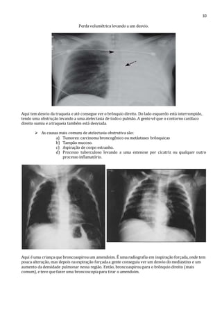 10 
Perda volumétrica levando a um desvio. 
Aqui tem desvio da traqueia e até consegue ver o brônquio direito. Do lado esquerdo está interrompido, 
tendo uma obstrução levando a uma atelectasia de todo o pulmão. A gente vê que o contorno cardíaco 
direito sumiu e a traqueia também está desviada. 
 As causas mais comuns de atelectasia obstrutiva são: 
a) Tumores: carcinoma broncogênico ou metástases brônquicas 
b) Tampão mucoso. 
c) Aspiração de corpo estranho. 
d) Processo tuberculoso levando a uma estenose por cicatriz ou qualquer outro 
processo inflamatório. 
Aqui é uma criança que broncoaspirou um amendoim. É uma radiografia em inspiração forçada, onde tem 
pouca alteração, mas depois na expiração forçada a gente conseguiu ver um desvio do mediastino e um 
aumento da densidade pulmonar nessa região. Então, broncoaspirou para o brônquio direito (mais 
comum), e teve que fazer uma broncoscopia para tirar o amendoim. 
 