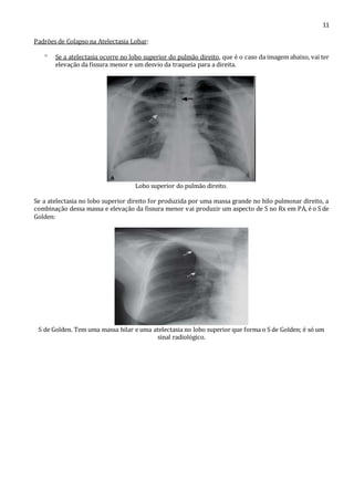 11 
Padrões de Colapso na Atelectasia Lobar: 
 Se a atelectasia ocorre no lobo superior do pulmão direito, que é o caso da imagem abaixo, vai ter 
elevação da fissura menor e um desvio da traqueia para a direita. 
Lobo superior do pulmão direito. 
Se a atelectasia no lobo superior direito for produzida por uma massa grande no hilo pulmonar direito, a 
combinação dessa massa e elevação da fissura menor vai produzir um aspecto de S no Rx em PA, é o S de 
Golden: 
S de Golden. Tem uma massa hilar e uma atelectasia no lobo superior que forma o S de Golden; é só um 
sinal radiológico. 
 