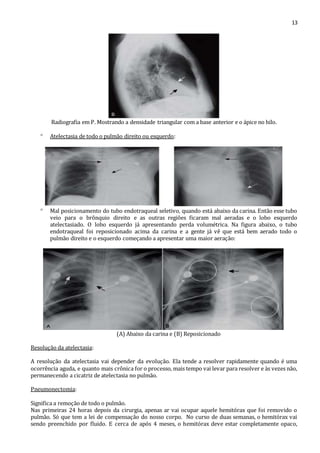 13 
Radiografia em P. Mostrando a densidade triangular com a base anterior e o ápice no hilo. 
 Atelectasia de todo o pulmão direito ou esquerdo: 
 Mal posicionamento do tubo endotraqueal seletivo, quando está abaixo da carina. Então esse tubo 
veio para o brônquio direito e as outras regiões ficaram mal aeradas e o lobo esquerdo 
atelectasiado. O lobo esquerdo já apresentando perda volumétrica. Na figura abaixo, o tubo 
endotraqueal foi reposicionado acima da carina e a gente já vê que está bem aerado todo o 
pulmão direito e o esquerdo começando a apresentar uma maior aeração: 
(A) Abaixo da carina e (B) Reposicionado 
Resolução da atelectasia: 
A resolução da atelectasia vai depender da evolução. Ela tende a resolver rapidamente quando é uma 
ocorrência aguda, e quanto mais crônica for o processo, mais tempo vai levar para resolver e às vezes não, 
permanecendo a cicatriz de atelectasia no pulmão. 
Pneumonectomia: 
Significa a remoção de todo o pulmão. 
Nas primeiras 24 horas depois da cirurgia, apenas ar vai ocupar aquele hemitórax que foi removido o 
pulmão. Só que tem a lei de compensação do nosso corpo. No curso de duas semanas, o hemitórax vai 
sendo preenchido por fluido. E cerca de após 4 meses, o hemitórax deve estar completamente opaco, 
 