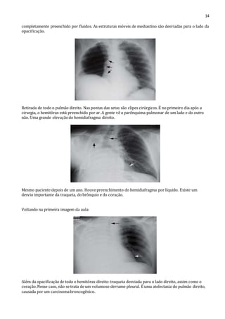 14 
completamente preenchido por fluidos. As estruturas móveis de mediastino são desviadas para o lado da 
opacificação. 
Retirada de todo o pulmão direito. Nas pontas das setas são clipes cirúrgicos. É no primeiro dia após a 
cirurgia, o hemitórax está preenchido por ar. A gente vê o parênquima pulmonar de um lado e do outro 
não. Uma grande elevação do hemidiafragma direito. 
Mesmo paciente depois de um ano. Houve preenchimento do hemidiafragma por líquido. Existe um 
desvio importante da traqueia, do brônquio e do coração. 
Voltando na primeira imagem da aula: 
Além da opacificação de todo o hemitórax direito: traqueia desviada para o lado direito, assim como o 
coração. Nesse caso, não se trata de um volumoso derrame pleural. É uma atelectasia do pulmão direito, 
causada por um carcinoma broncogênico. 
 