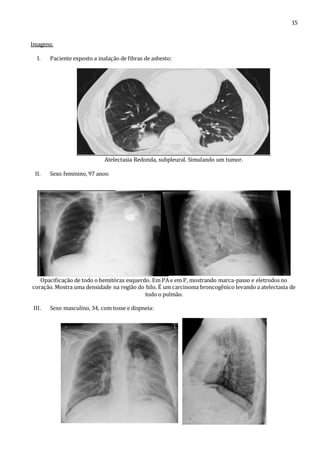 15 
Imagens: 
I. Paciente exposto a inalação de fibras de asbesto: 
Atelectasia Redonda, subpleural. Simulando um tumor. 
II. Sexo feminino, 97 anos: 
Opacificação de todo o hemitórax esquerdo. Em PA e em P, mostrando marca-passo e eletrodos no 
coração. Mostra uma densidade na região do hilo. É um carcinoma broncogênico levando a atelectasia de 
todo o pulmão. 
III. Sexo masculino, 34, com tosse e dispneia: 
 