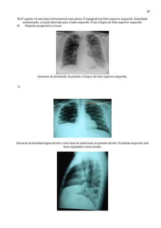 16 
No P a gente vê uma faixa retroesternal mais densa. É topografia de lobo superior esquerdo. Densidade 
aumentando, coração desviado para o lado esquerdo. É um colapso do lobo superior esquerdo. 
IV. Dispnéia progressiva e tosse: 
Aumento de densidade do pulmão. Colapso do lobo superior esquerdo. 
V. 
Elevação do hemidiafragma direito e uma faixa de atelectasia no pulmão direito. O pulmão esquerdo está 
bem expandido e bem aerado. 
 