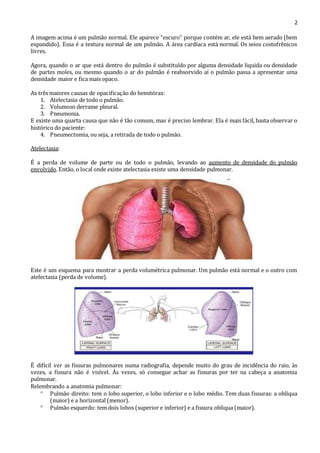 2 
A imagem acima é um pulmão normal. Ele aparece “escuro” porque contém ar, ele está bem aerado (bem 
expandido). Essa é a textura normal de um pulmão. A área cardíaca está normal. Os seios costofrênicos 
livres. 
Agora, quando o ar que está dentro do pulmão é substituído por alguma densidade liquida ou densidade 
de partes moles, ou mesmo quando o ar do pulmão é reabsorvido aí o pulmão passa a apresentar uma 
densidade maior e fica mais opaco. 
As três maiores causas de opacificação do hemitórax: 
1. Atelectasia de todo o pulmão. 
2. Volumoso derrame pleural. 
3. Pneumonia. 
E existe uma quarta causa que não é tão comum, mas é preciso lembrar. Ela é mais fácil, basta observar o 
histórico do paciente: 
4. Pneumectomia, ou seja, a retirada de todo o pulmão. 
Atelectasia: 
É a perda de volume de parte ou de todo o pulmão, levando ao aumento de densidade do pulmão 
envolvido. Então, o local onde existe atelectasia existe uma densidade pulmonar. 
Este é um esquema para mostrar a perda volumétrica pulmonar. Um pulmão está normal e o outro com 
atelectasia (perda de volume). 
É difícil ver as fissuras pulmonares numa radiografia, depende muito do grau de incidência do raio, às 
vezes, a fissura não é visível. Às vezes, só consegue achar as fissuras por ter na cabeça a anatomia 
pulmonar. 
Relembrando a anatomia pulmonar: 
 Pulmão direito: tem o lobo superior, o lobo inferior e o lobo médio. Tem duas fissuras: a oblíqua 
(maior) e a horizontal (menor). 
 Pulmão esquerdo: tem dois lobos (superior e inferior) e a fissura obliqua (maior). 
 