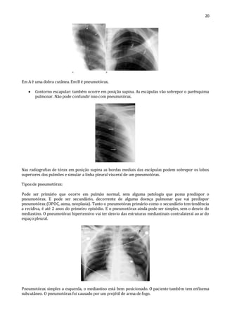 20 
Em A é uma dobra cutânea. Em B é pneumotórax. 
 Contorno escapular: também ocorre em posição supina. As escápulas vão sobrepor o parênquima 
pulmonar. Não pode confundir isso com pneumotórax. 
Nas radiografias de tórax em posição supina as bordas mediais das escápulas podem sobrepor os lobos 
superiores dos pulmões e simular a linha pleural visceral de um pneumotórax. 
Tipos de pneumotórax: 
Pode ser primário que ocorre em pulmão normal, sem alguma patologia que possa predispor o 
pneumotórax. E pode ser secundário, decorrente de alguma doença pulmonar que vai predispor 
pneumotórax (DPOC, asma, neoplasia). Tanto o pneumotórax primário como o secundário tem tendência 
a recidiva, é até 2 anos do primeiro episódio. E o pneumotórax ainda pode ser simples, sem o desvio do 
mediastino. O pneumotórax hipertensivo vai ter desvio das estruturas mediastinais contralateral ao ar do 
espaço pleural. 
Pneumotórax simples a esquerda, o mediastino está bem posicionado. O paciente também tem enfisema 
subcutâneo. O pneumotórax foi causado por um projétil de arma de fogo. 
 