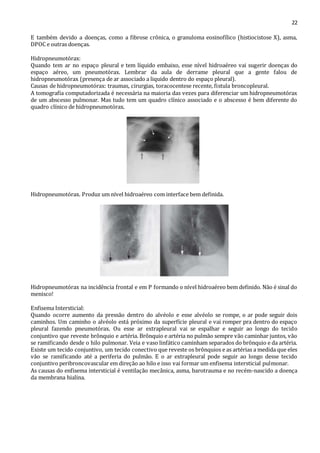 22 
E também devido a doenças, como a fibrose crônica, o granuloma eosinofílico (histiocistose X), asma, 
DPOC e outras doenças. 
Hidropneumotórax: 
Quando tem ar no espaço pleural e tem líquido embaixo, esse nível hidroaéreo vai sugerir doenças do 
espaço aéreo, um pneumotórax. Lembrar da aula de derrame pleural que a gente falou de 
hidropneumotórax (presença de ar associado a liquido dentro do espaço pleural). 
Causas de hidropneumotórax: traumas, cirurgias, toracocentese recente, fistula broncopleural. 
A tomografia computadorizada é necessária na maioria das vezes para diferenciar um hidropneumotórax 
de um abscesso pulmonar. Mas tudo tem um quadro clínico associado e o abscesso é bem diferente do 
quadro clínico de hidropneumotórax. 
Hidropneumotórax. Produz um nível hidroaéreo com interface bem definida. 
Hidropneumotórax na incidência frontal e em P formando o nível hidroaéreo bem definido. Não é sinal do 
menisco! 
Enfisema Intersticial: 
Quando ocorre aumento da pressão dentro do alvéolo e esse alvéolo se rompe, o ar pode seguir dois 
caminhos. Um caminho o alvéolo está próximo da superfície pleural e vai romper pra dentro do espaço 
pleural fazendo pneumotórax. Ou esse ar extrapleural vai se espalhar e seguir ao longo do tecido 
conjuntivo que reveste brônquio e artéria. Brônquio e artéria no pulmão sempre vão caminhar juntos, vão 
se ramificando desde o hilo pulmonar. Veia e vaso linfático caminham separados do brônquio e da artéria. 
Existe um tecido conjuntivo, um tecido conectivo que reveste os brônquios e as artérias a medida que eles 
vão se ramificando até a periferia do pulmão. E o ar extrapleural pode seguir ao longo desse tecido 
conjuntivo peribroncovascular em direção ao hilo e isso vai formar um enfisema intersticial pulmonar. 
As causas do enfisema intersticial é ventilação mecânica, asma, barotrauma e no recém-nascido a doença 
da membrana hialina. 
 