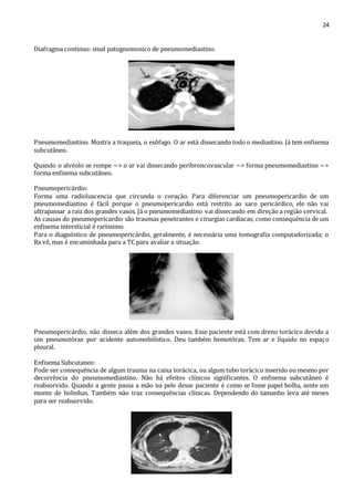 24 
Diafragma continuo: sinal patognomonico de pneumomediastino. 
Pneumomediastino. Mostra a traqueia, o esôfago. O ar está dissecando todo o mediastino. Já tem enfisema 
subcutâneo. 
Quando o alvéolo se rompe ~> o ar vai dissecando peribroncovascular ~> forma pneumomediastino ~> 
forma enfisema subcutâneo. 
Pneumopericárdio: 
Forma uma radioluscencia que circunda o coração. Para diferenciar um pneumopericardio de um 
pneumomediastino é fácil porque o pneumopericardio está restrito ao saco pericárdico, ele não vai 
ultrapassar a raiz dos grandes vasos. Já o pneumomediastino vai dissecando em direção a região cervical. 
As causas do pneumopericardio são traumas penetrantes e cirurgias cardíacas; como consequência de um 
enfisema intersticial é raríssimo. 
Para o diagnóstico de pneumopericárdio, geralmente, é necessária uma tomografia computadorizada; o 
Rx vê, mas é encaminhada para a TC para avaliar a situação. 
Pneumopericárdio, não disseca além dos grandes vasos. Esse paciente está com dreno torácico devido a 
um pneumotórax por acidente automobilístico. Deu também hemotórax. Tem ar e líquido no espaço 
pleural. 
Enfisema Subcutaneo: 
Pode ser consequência de algum trauma na caixa torácica, ou algum tubo torácico inserido ou mesmo por 
decorrência do pneumomediastino. Não há efeitos clínicos significantes. O enfisema subcutâneo é 
reabsorvido. Quando a gente passa a mão na pele desse paciente é como se fosse papel bolha, sente um 
monte de bolinhas. Também não traz consequências clínicas. Dependendo do tamanho leva até meses 
para ser reabsorvido. 
 
