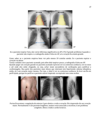 27 
Se o paciente respirar bem, não vai ter diferença significativa no AP e PA. O grande problema é quando o 
paciente não respira e a radiografia ainda é feita em AP, aí o coração fica muito grande. 
Como saber se o paciente respirou bem: ver pelo menos 10 costelas saindo. Se o paciente expirar o 
coração vai deitar. 
Tomar cuidado com o paciente acamado, pois além dele inspirar pouco, a radiografia é feita em AP. 
Quando pegar um coração grande no paciente acamado é preciso ver os contornos cardíacos, ver os vasos 
e até onde eles estão chegando, ou seja, achar sinais secundários de cardiopatia para justificar a 
cardiomegalia. Boa parte dos pacientes mais idosos que internam tem hipertensão sistema idiopática, 
então, já é um coração maior mesmo. Por isso, o ideal é ver os contornos cardíacos. Se tiver um Rx em 
perfil ajuda, porque no perfil se o paciente estiver inspirado ou expirado tem como avaliar. 
Pectus Escavatum: a angulação do esterno é para dentro e roda o coração. Dá a impressão de um coração 
maior. Normalmente é um paciente longilíneo, muitas vezes associado a escoliose, é um problema 
congênito. Altera o índice cardio torácico. 
 