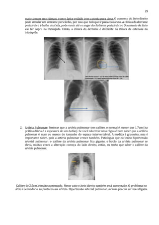 29 
mais comum em crianças, com o ápice rodado com a ponta para cima. O aumento do átrio direito 
pode simular um derrame pericárdio, por isso que tem que ir para ecocardio. A clínica do derrame 
pericárdico é bulha abafada, pode ouvir até o ranger dos folhetos pericárdicos. O aumento de átrio 
vai ter sopro na tricúspide. Então, a clínica do derrame é diferente da clínica de estenose da 
tricúspide. 
2. Artéria Pulmonar: lembrar que a artéria pulmonar tem calibre, o normal é menor que 1.7cm (na 
prática diária é a espessura de um dedão). Se você não tiver uma régua é bom saber que a artéria 
pulmonar é mais ou menos do tamanho do espaço intervertebral. A medida é grosseira, mas é 
importante saber, pois a artéria pulmonar cresce também. Patologias que eu tenho hipertensão 
arterial pulmonar: o calibre da artéria pulmonar fica gigante, o botão da artéria pulmonar se 
eleva, muitas vezes a alteração começa do lado direito, então, eu tenho que saber o calibre da 
artéria pulmonar. 
Calibre de 2.5cm, é muito aumentado. Nesse caso o átrio direito também está aumentado. O problema no 
átrio é secundário ao problema na artéria. Hipertensão arterial pulmonar, a causa precisa ser investigada. 
 