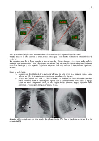 3 
Uma lesão no lobo superior do pulmão direito vai ser uma lesão na região superior do tórax. 
O lobo médio e o lobo inferior já estão abaixo. Sendo que o lobo médio é anterior e o lobo inferior é 
posterior. 
No pulmão esquerdo: o lobo superior é antero-superior. Então, algumas vezes, uma lesão no lobo 
superior pode dar embaixo e isso é lobo superior (olha a figura acima). Na radiografia de perfil dá para 
identificar bem que o lobo superior do pulmão esquerdo está anteriorizado. O lobo inferior é postero-inferior. 
Sinais de atelectasia: 
1. Aumento da densidade da área pulmonar afetada. Ou seja, perde o ar naquela região, perde 
volume por falta de ar e existe uma densidade naquela região afetada. 
2. Desvio das fissuras interlobares (entre os lobos) em direção a área atelectasiada. Ou seja, 
perde volume e puxa as fissuras para aquele lado. O corpo humano nunca deixa o espaço 
vazio, ele tenta compensar. Então, se uma região perdeu volume a região adjacente tenta 
aumentar o volume para compensar aquela perda. 
A região atelectasiada está no lobo médio do pulmão direito (A). Desvio das fissuras para a área de 
atelectasia (B). 
 