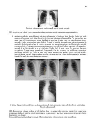 30 
A artéria pulmonar está muito grande e o átrio está normal. 
OBS: Lembrar que o átrio cresce, aumenta, roda pra cima, a artéria pulmonar aumenta calibre. 
3. Aorta Ascendente: a medida dela não deve ultrapassar o limite do átrio direito. Então, ela pode 
crescer até encostar-se à linha do átrio direito, mas não deve ultrapassá-la. Por que eu falo que 
pode crescer? Porque com o passar da idade, a aorta vai ficando cada vez mais alongada (isso é 
normal). Então, o normal da aorta é ela ir ficando ectesiada, alongada; mas não pode passar da 
projeção do átrio pois aí eu já começo a pensar em aneurisma, dissecção, hipertensão arterial, 
estenose aórtica (causa comum de aumento de aorta ascendente). Se fizer o eco e a válvula estiver 
normal, é só hipertensão arterial sistêmica. Então, HAS é uma causa de aumento da aorta 
ascendente. É para gravar quando ela fica grande. Ela fica pequena em problemas congênitos, 
problemas pediátricos. Então, o que mais causa aumento da aorta é doença aterosclerótica 
(deposição de placas), hipertensão arterial e estenose aórtica; existe ainda coarctação aórtica e 
insuficiência aórtica, mas são menos comuns. 
A ultima figura mostra o átrio e a aorta ascendente. O mais comum é a hipercolesterolemia associada a 
hipertensão arterial. 
OBS: Estenose da válvula aórtica: a válvula fica dura e o sangue não consegue passar. E o corpo tenta 
compensar dilatando a aorta. Isso é uma regra no corpo, sempre que tiver uma estenose o vaso pra frente 
da estenose vai alargar. 
Então, o átrio aumenta, roda pra cima, já falamos da artéria pulmonar e da aorta ascendente. 
 