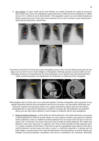 31 
4. Arco aórtico: eu meço aonde ela faz uma bolinha, um cajado (chamado de cajado da aorta). Eu 
meço menor que 3.5cm. Em radiografia a gente pode usar o calibre da aorta ascendente 4 e calibre 
do arco 3.5 e calibre da aorta descendente 3. Na topografia a gente usa uma tabela baseada em 
idade e posição da aorta. O que mais causa aumento do arco são as mesmas causas: hipertensão + 
aterosclerose, dissecções e aneurismas. 
O paciente com mais de 5cm tem que ir para tomográfica, nesse caso o eco não adianta muito pois ele não 
pega o arco, só se for um eco trans esofágico. A tomografia é indicada, porque eu preciso saber se é um 
aneurisma de aorta, se é uma dissecção da aorta ascendente ou se é apenas uma aorta aterosclerótica. 
Então, aumentos grandes com alargamento de mediastino, eu tenho que fazer tomografia. 
Nessa imagem mal vê o átrio, pois o arco está muito grande. Foi feita a tomografia, onde é possível ver um 
grande aneurisma tanto da aorta ascendente como do arco da aorta, é um aneurisma calcificado, sem 
dissecção. É apenas um aneurisma. Nesse caso, a gente precisa ficar esperto pelo risco de ruptura, 
principalmente se o paciente for hipertenso e mantiver a pressão alta. Normalmente, são pacientes 
idosos, por isso não vamos submeter a uma cirurgia se realmente não for uma emergência. 
5. Botão da Artéria Pulmonar: eu falo botão da artéria pulmonar e não artéria pulmonar, isso porque 
a artéria pulmonar eu vejo ela do lado direito. Eu vejo contorno cardíaco, que equivale a saída da 
artéria pulmonar. Como é a medida da artéria pulmonar? Eu vou traçar uma reta que vai do arco 
aórtico até o ventrículo. Vou traçar uma outra reta na saída da artéria pulmonar. Vou medir essa 
distância, existe uma regra que é o seguinte: até 1.5cm, é muito próximo do lado esquerdo que é 
1.7, a gente considera os dois lados 1.5 pra não ter que ficar guardando tanto número. Hora que a 
artéria pulmonar encosta nessa reta entre a aorta e o ventrículo esquerdo é o máximo que ela 
pode chegar, se passou dessa reta é sinal de hipertensão arterial pulmonar. Se afastar demais, por 
exemplo, 2cm provavelmente o problema é da aorta ou o problema é do ventrículo. Alterações 
 
