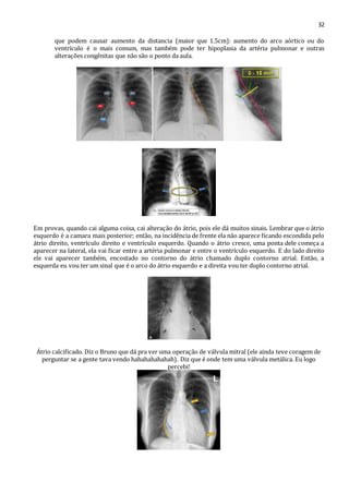 32 
que podem causar aumento da distancia (maior que 1.5cm): aumento do arco aórtico ou do 
ventrículo é o mais comum, mas também pode ter hipoplasia da artéria pulmonar e outras 
alterações congênitas que não são o ponto da aula. 
Em provas, quando cai alguma coisa, cai alteração do átrio, pois ele dá muitos sinais. Lembrar que o átrio 
esquerdo é a camara mais posterior; então, na incidência de frente ela não aparece ficando escondida pelo 
átrio direito, ventrículo direito e ventrículo esquerdo. Quando o átrio cresce, uma ponta dele começa a 
aparecer na lateral, ela vai ficar entre a artéria pulmonar e entre o ventrículo esquerdo. E do lado direito 
ele vai aparecer também, encostado no contorno do átrio chamado duplo contorno atrial. Então, a 
esquerda eu vou ter um sinal que é o arco do átrio esquerdo e a direita vou ter duplo contorno atrial. 
Átrio calcificado. Diz o Bruno que dá pra ver uma operação de válvula mitral (ele ainda teve coragem de 
perguntar se a gente tava vendo hahahahahahah). Diz que é onde tem uma válvula metálica. Eu logo 
percebi! 
 