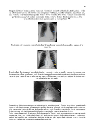 33 
Imagem mostrando botão da artéria pulmonar, o ventrículo esquerdo está embaixo. Então, entre o botão 
da artéria pulmonar que está normal nessa imagem e o ventrículo, eu tenho uma ponta. Deveria ser liso, 
essa pontinha equivale ao átrio esquerdo. Do lado direito eu tenho atrio direito e tem um outro contorno 
por dentro que equivale ao átrio aumentado. Então, contorno do átrio direito e contorno do átrio 
esquerdo são os dois sinais que aparecem na radiografia em PA. 
Mostrando outro exemplo: entre o botão da artéria pulmonar e ventrículo esquerdo, o arco do átrio 
esquerdo. 
E aqui no lado direito a gente tem o átrio direito, e esse outro contorno atrial; é como se tivesse uma bola 
dentro da outra. Essa bola branca equivale ao átrio esquerdo aumentado; então, eu tenho duplo contorno 
e arco do átrio esquerdo que geralmente não aparece. Muitas vezes a gente tem o arco do átrio esquerdo e 
do lado direito não tem nada. 
Quais outros sinais de aumento do átrio esquerdo eu posso encontrar? Como o átrio cresce para cima, ele 
empurra o brônquio para o lado esquerdo também. Então, o brônquio vai ficar cada vez mais retificado, 
principalmente o esquerdo. Ele vai retificando cada vez mais, ficando perpendicular. Isso é mais um sinal 
de livro, porque o brônquio esquerdo já é mais perpendicular em relação ao lado direito. 
Então, quais são os sinais de aumento do átrio esquerdo? Duplo contorno, aumento do arco entre artéria 
pulmonar e ventrículo, retificação brônquica. E antigamente, quando ainda não existia o ecocardiograma, 
poderia ver também na radiografia o esôfago rechaçado para algum lado. Quando o átrio esquerdo 
empurra o esôfago, ele empurra para esquerda e para trás. 
 