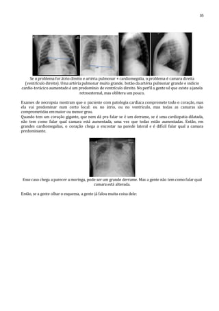 35 
Se o problema for átrio direito e artéria pulmonar + cardiomegalia, o problema é camara direita 
(ventrículo direito). Uma artéria pulmonar muito grande, botão da artéria pulmonar grande e indicio 
cardio-torácico aumentado é um predomínio de ventrículo direito. No perfil a gente vê que existe a janela 
retroesternal, mas oblitera um pouco. 
Exames de necropsia mostram que o paciente com patologia cardíaca compromete todo o coração, mas 
ela vai predominar num certo local: ou no átrio, ou no ventrículo, mas todas as camaras são 
comprometidas em maior ou menor grau. 
Quando tem um coração gigante, que nem dá pra falar se é um derrame, se é uma cardiopatia dilatada, 
não tem como falar qual camara está aumentada, uma vez que todas estão aumentadas. Então, em 
grandes cardiomegalias, o coração chega a encostar na parede lateral e é difícil falar qual a camara 
predominante. 
Esse caso chega a parecer a moringa, pode ser um grande derrame. Mas a gente não tem como falar qual 
camara está alterada. 
Então, se a gente olhar o esquema, a gente já falou muita coisa dele: 
 
