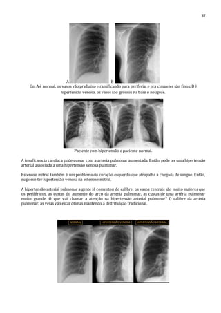 37 
A B 
Em A é normal, os vasos vão pra baixo e ramificando para periferia; e pra cima eles são finos. B é 
hipertensão venosa, os vasos são grossos na base e no apice. 
Paciente com hipertensão e paciente normal. 
A insuficiencia cardíaca pode cursar com a arteria pulmonar aumentada. Então, pode ter uma hipertensão 
arterial associada a uma hipertensão venosa pulmonar. 
Estenose mitral também é um problema do coração esquerdo que atrapalha a chegada de sangue. Então, 
eu posso ter hipertensão venosa na estenose mitral. 
A hipertensão arterial pulmonar a gente já comentou do calibre: os vasos centrais são muito maiores que 
os periféricos, as custas do aumento do arco da arteria pulmonar, as custas de uma artéria pulmonar 
muito grande. O que vai chamar a atenção na hipertensão arterial pulmonar? O calibre da artéria 
pulmonar, as veias vão estar ótimas mantendo a distribuição tradicional. 
 