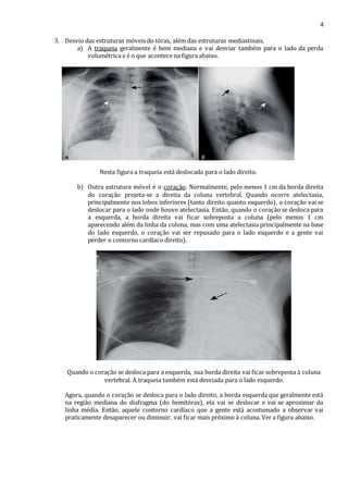 4 
3. Desvio das estruturas móveis do tórax, além das estruturas mediastinais. 
a) A traqueia geralmente é bem mediana e vai desviar também para o lado da perda 
volumétrica e é o que acontece na figura abaixo. 
Nesta figura a traqueia está deslocada para o lado direito. 
b) Outra estrutura móvel é o coração. Normalmente, pelo menos 1 cm da borda direita 
do coração projeta-se a direita da coluna vertebral. Quando ocorre atelectasia, 
principalmente nos lobos inferiores (tanto direito quanto esquerdo), o coração vai se 
deslocar para o lado onde houve atelectasia. Então, quando o coração se desloca para 
a esquerda, a borda direita vai ficar sobreposta a coluna (pelo menos 1 cm 
aparecendo além da linha da coluna, mas com uma atelectasia principalmente na base 
do lado esquerdo, o coração vai ser repuxado para o lado esquerdo e a gente vai 
perder o contorno cardíaco direito). 
Quando o coração se desloca para a esquerda, sua borda direita vai ficar sobreposta à coluna 
vertebral. A traqueia também está desviada para o lado esquerdo. 
Agora, quando o coração se desloca para o lado direito, a borda esquerda que geralmente está 
na região mediana do diafragma (do hemitórax), ela vai se deslocar e vai se aproximar da 
linha média. Então, aquele contorno cardíaco que a gente está acostumado a observar vai 
praticamente desaparecer ou diminuir, vai ficar mais próximo à coluna. Ver a figura abaixo. 
 